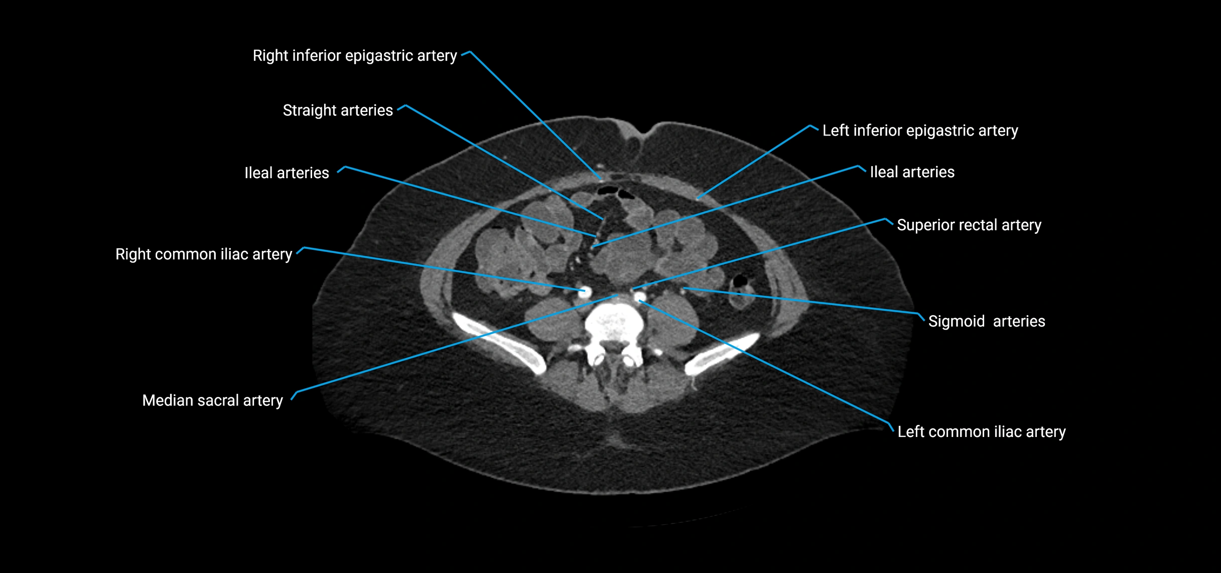 CTA abdomen axial cross sectional anatomy labelled image_157 (2).webp